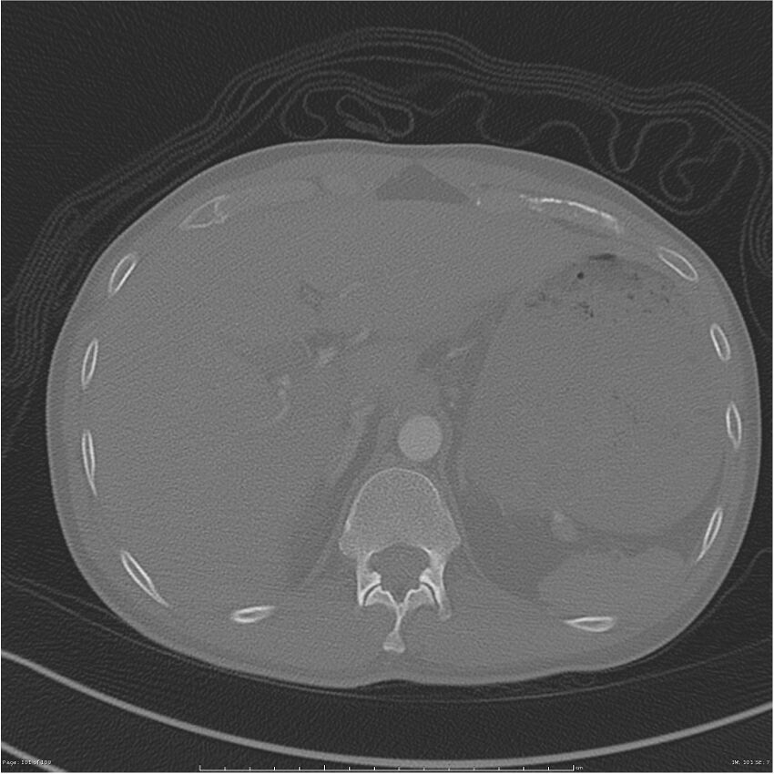 Chest and abdomen multi-trauma (Radiopaedia 26294-26425 bone window 101).jpg