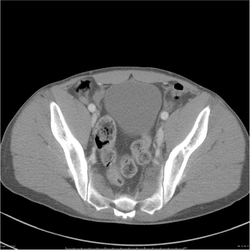 Chest and abdomen multi-trauma (Radiopaedia 26294-26426 A 72).jpg