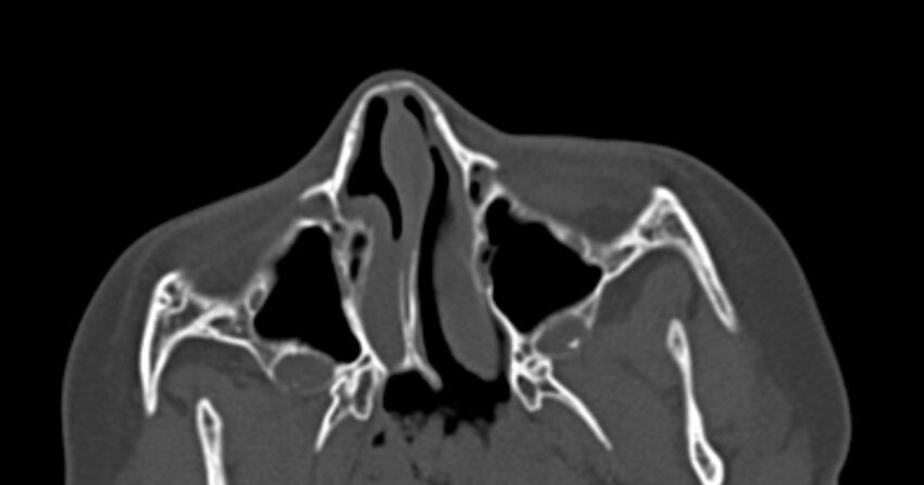 Choanal atresia (Radiopaedia 51295-56972 Axial bone window 23).jpg