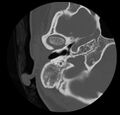 Cholesteatoma (Radiopaedia 20296-20217 bone window 18).jpg