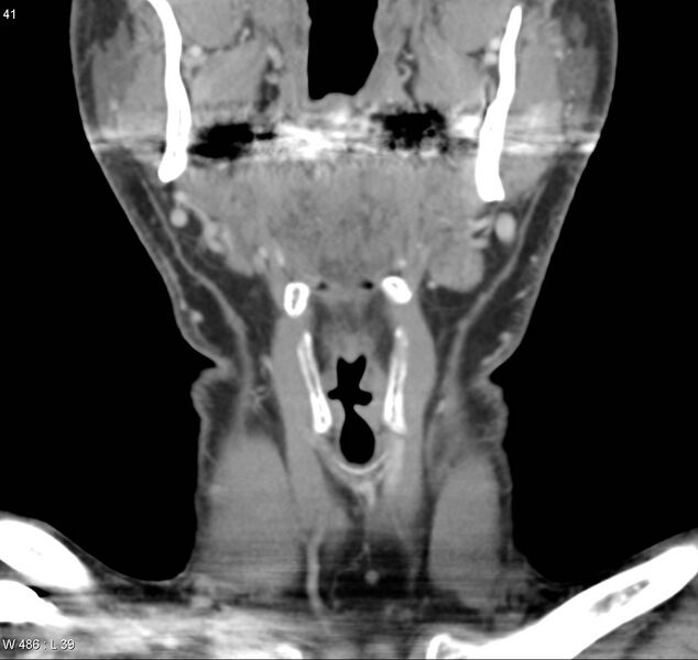 File:Chondrosarcoma - larynx (Radiopaedia 4588-6698 B 6).jpg