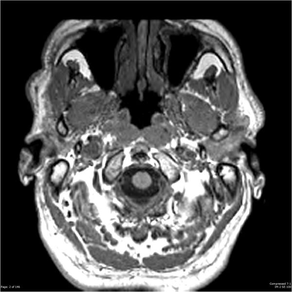 File:Chondrosarcoma of skull base- grade II (Radiopaedia 40948-43654 Axial T1 2).jpg