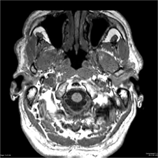 File:Chondrosarcoma of skull base- grade II (Radiopaedia 40948-43654 Axial T1 3).jpg