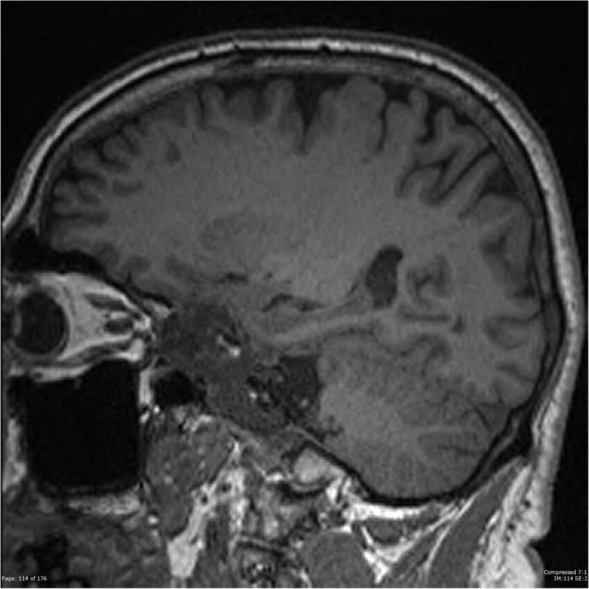 Chondrosarcoma of skull base- grade II (Radiopaedia 40948-43654 Sagittal T1 37).jpg