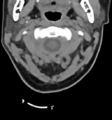 Chordoma (C4 vertebra) (Radiopaedia 47561-52188 Axial non-contrast 11).png