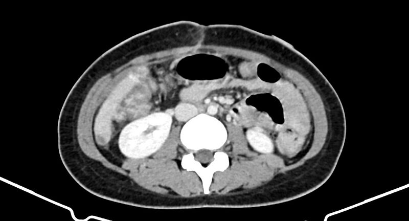 File:Choriocarcinoma liver metastases (Radiopaedia 74768-85766 A 112).jpg