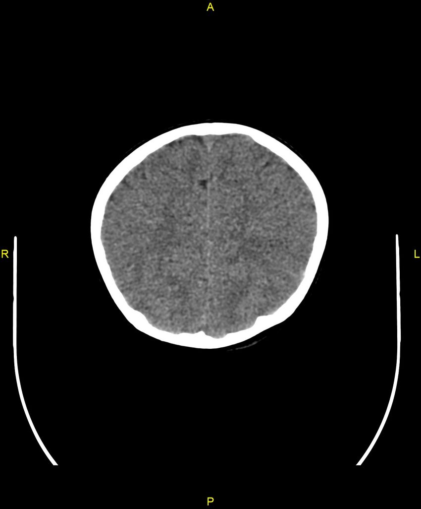 Choroidal fissure cyst (Radiopaedia 89481-106465 Axial non-contrast 96).jpg