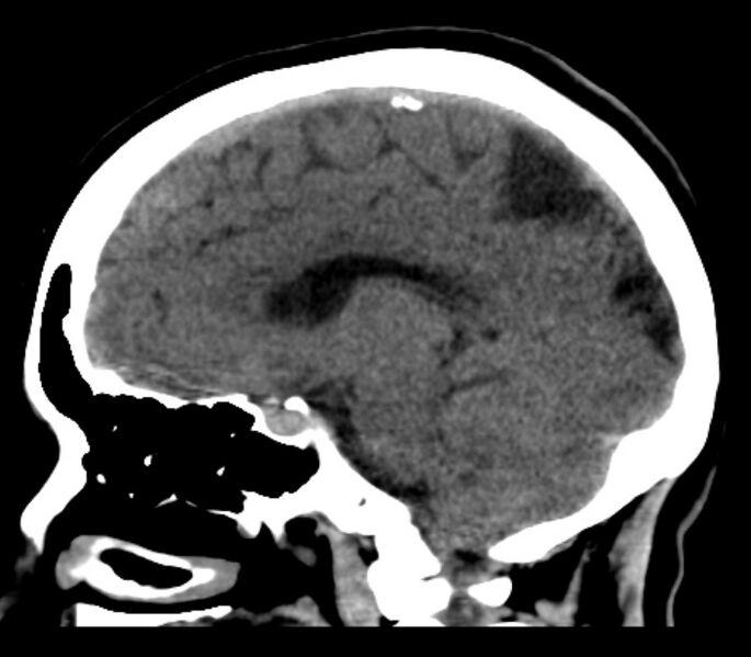 File:Chronic bilateral occipital lobe infarcts (Radiopaedia 31276-31996 C 19).jpg