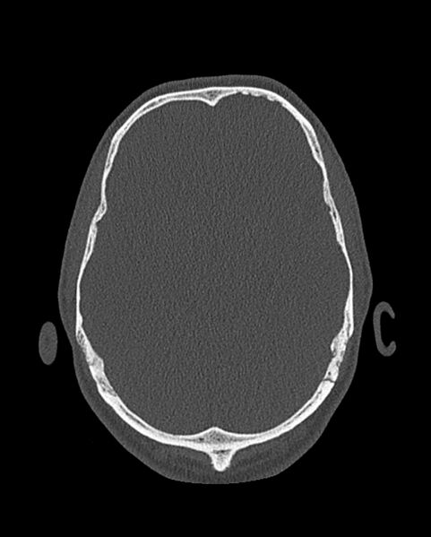 File:Chronic maxillary sinusitis caused by a foreign body (Radiopaedia 58521-65676 Axial bone window 329).jpg