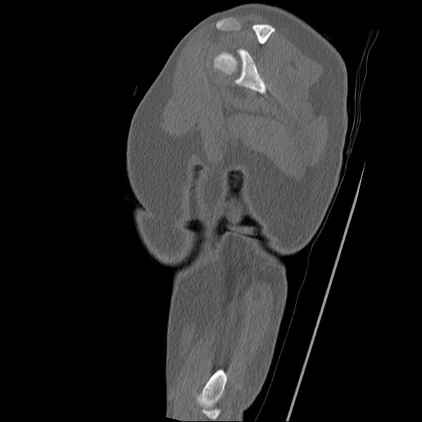File:Chronic osteomyelitis (Radiopaedia 67597-76998 Sagittal bone window 5).jpg