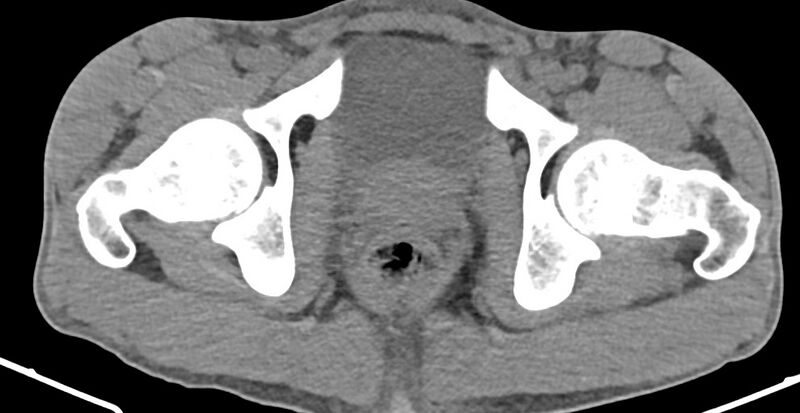 File:Chronic osteomyelitis (with sequestrum) (Radiopaedia 74813-85822 D 41).jpg