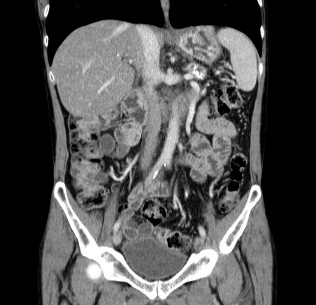 File:Chronic pancreatitis (Radiopaedia 23132-23172 C 30).jpg