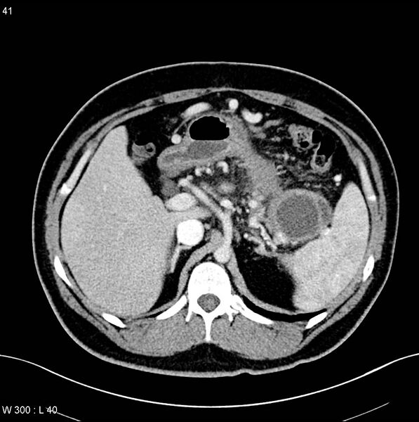 File:Chronic pancreatitis and pseudocysts (Radiopaedia 6724-7935 B 4).jpg