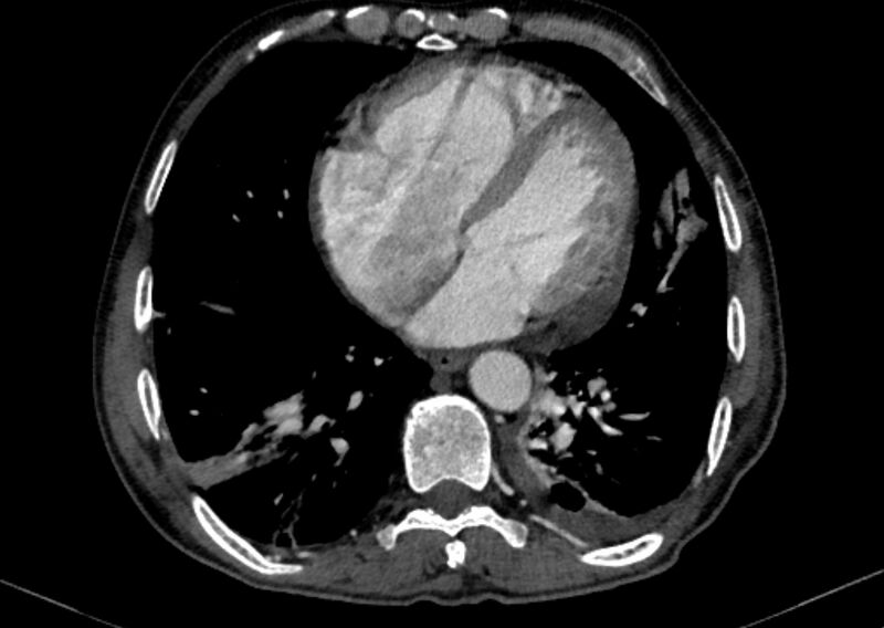 File:Chronic pulmonary embolism with bubbly consolidation (Radiopaedia 91248-108850 C+ arterial phase 106).jpg