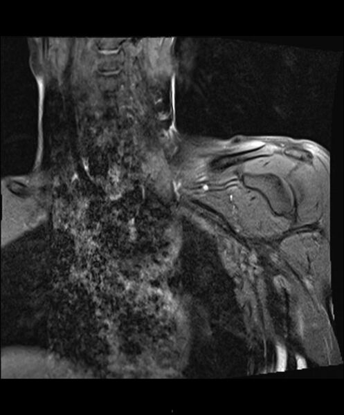 File:Chronic reactive multifocal osteomyelitis (CRMO) - clavicle (Radiopaedia 56406-63114 Coronal T1 fat sat 2).jpg