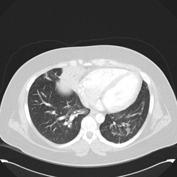 File:Chronic thromboembolic pulmonary hypertension (CTEPH) (Radiopaedia 74597-85531 Axial lung window 35).jpg