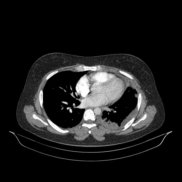 File:Chronic thromboembolic pulmonary hypertension (CTEPH) (Radiopaedia 74597-85532 Axial C+ CTPA 75).jpg