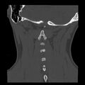 Clay-shoveler fracture (Radiopaedia 22568-22590 Coronal bone window 33).jpg
