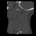 Clay-shoveler fracture (Radiopaedia 22568-22590 Sagittal bone window 45).jpg