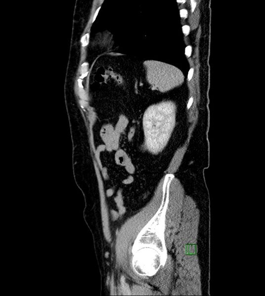 File:Clear cell renal cell carcinoma (Radiopaedia 85006-100539 G 13).jpg