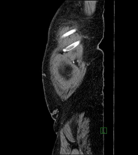 File:Closed-loop small bowel obstruction-internal hernia (Radiopaedia 78439-91096 C 133).jpg