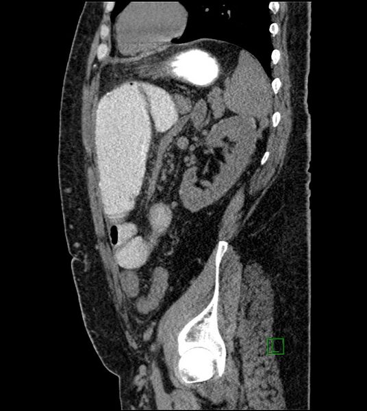 File:Closed-loop small bowel obstruction-internal hernia (Radiopaedia 78439-91096 C 48).jpg