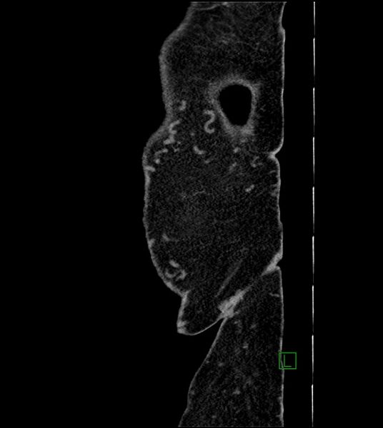 File:Closed-loop small bowel obstruction-internal hernia (Radiopaedia 78439-91096 C 9).jpg
