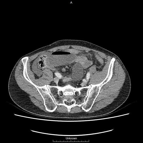 File:Closed loop bowel obstruction and ischemia (Radiopaedia 86959-103180 A 66).jpg