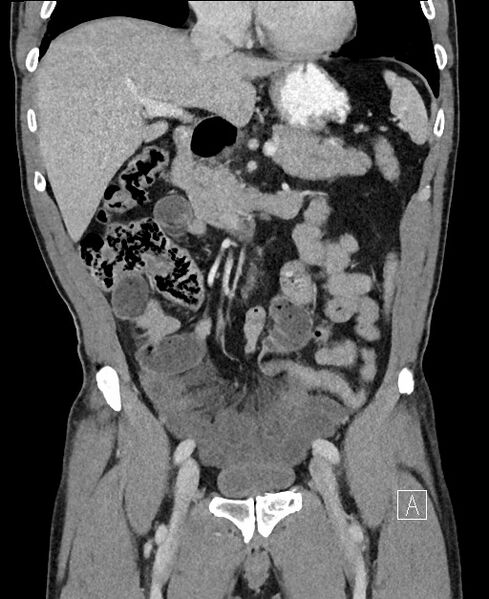 File:Closed loop small bowel obstruction - internal hernia (Radiopaedia 57806-64778 A 47).jpg