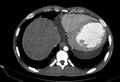 Coarctation of aorta with aortic valve stenosis (Radiopaedia 70463-80574 A 190).jpg