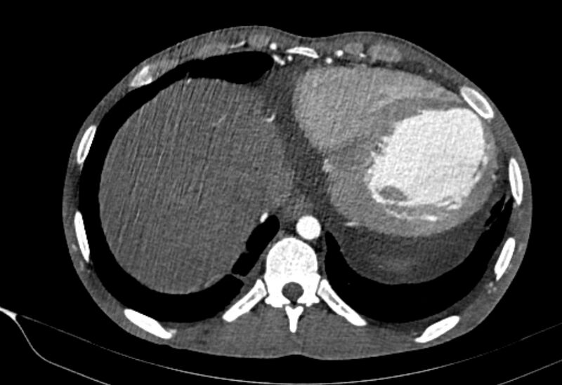 File:Coarctation of aorta with aortic valve stenosis (Radiopaedia 70463-80574 A 194).jpg