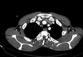 Coarctation of aorta with aortic valve stenosis (Radiopaedia 70463-80574 A 4).jpg