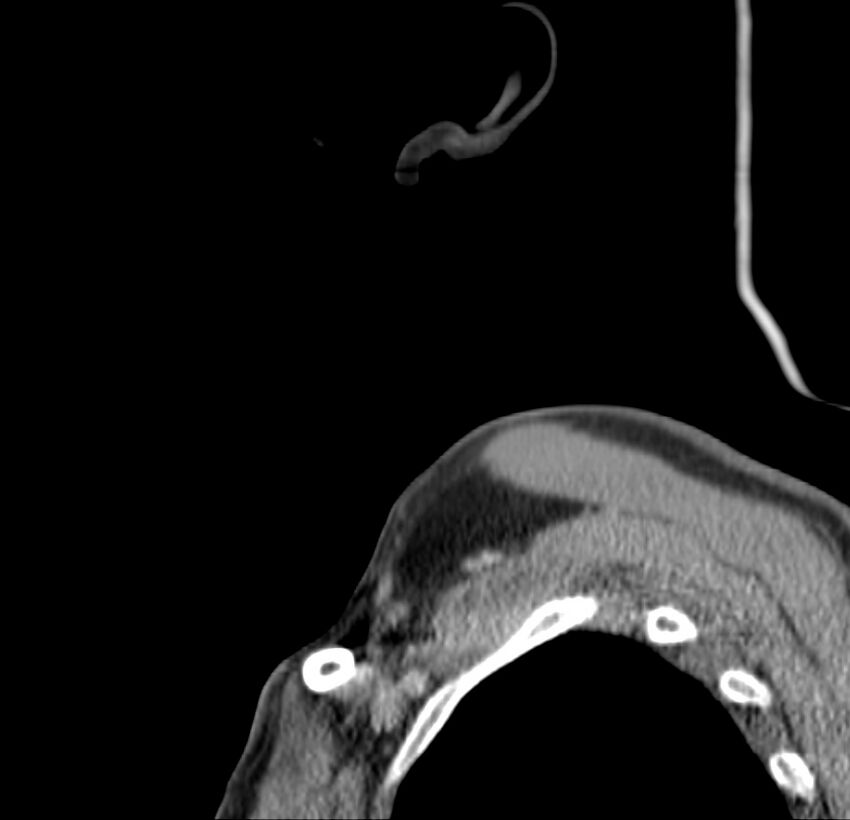 Colloid cyst of thyroid (Radiopaedia 22897-22923 Sagittal C+ delayed 2).jpg