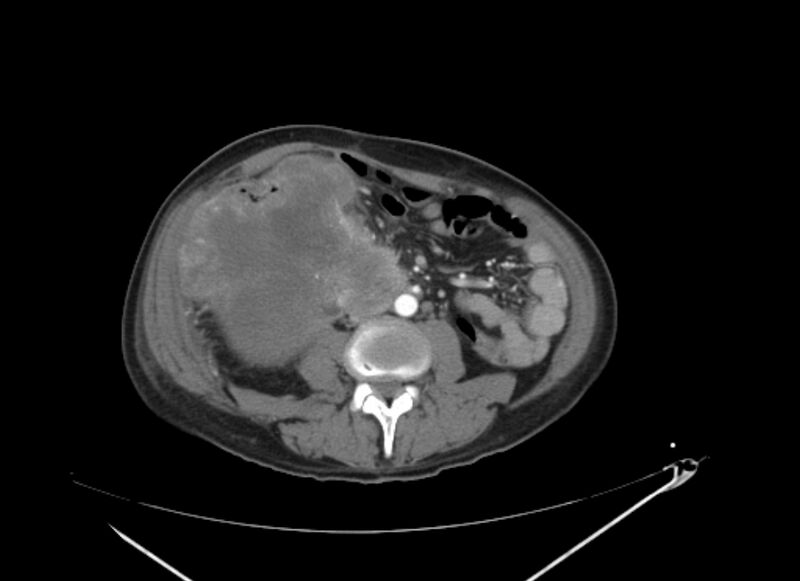 File:Colon cancer mimicking renal cell carcinoma (Radiopaedia 28986-29335 B 43).jpg
