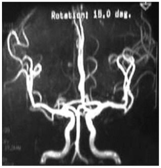Cerebral vessels by brain MRA show cerebral atherosclerosis (and minor angiostenosis)