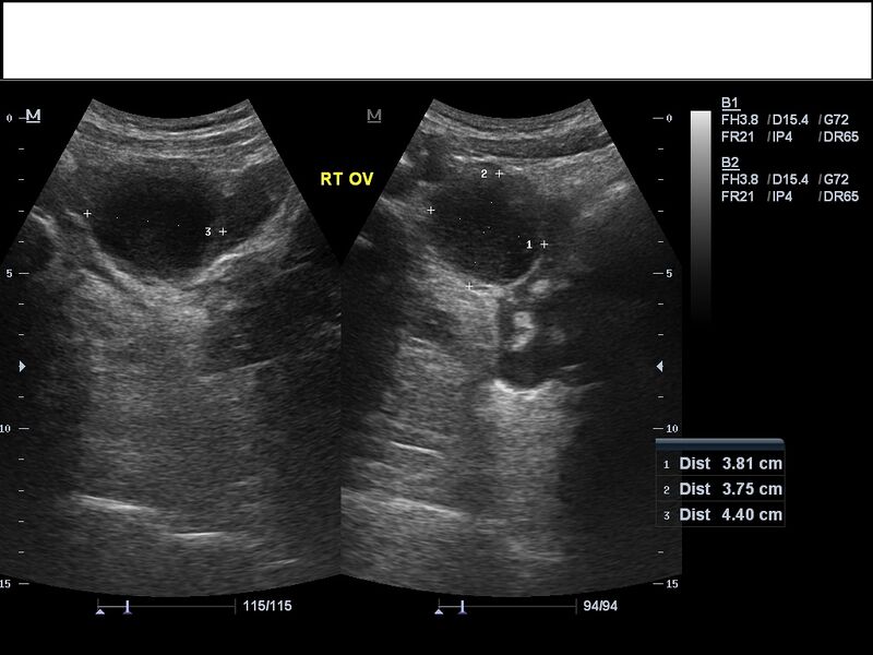 File:Hemorrhagic ovarian cyst (Radiopaedia 16733).jpg