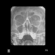 X-ray skull: Osteoma of the frontal sinus