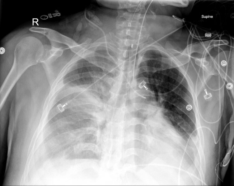 File:Malpositioned right internal jugular vein catheter (Radiopaedia 56505).jpg