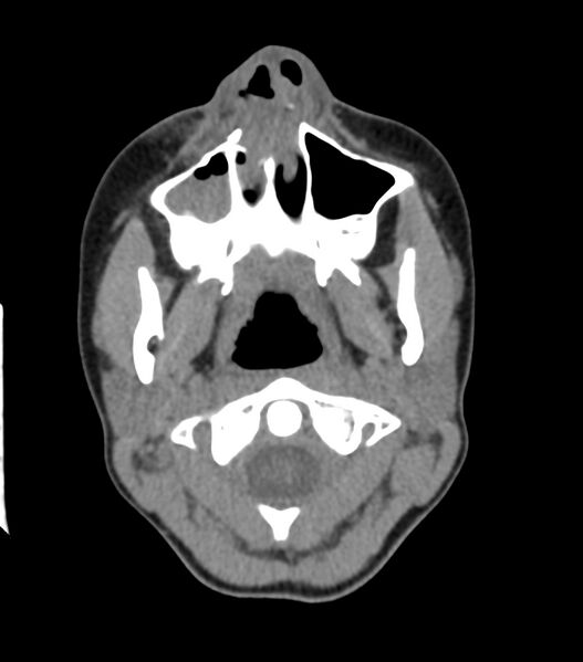 File:Nasoorbitoethmoid fracture (Radiopaedia 90044-107205 Axial non-contrast 107).jpg