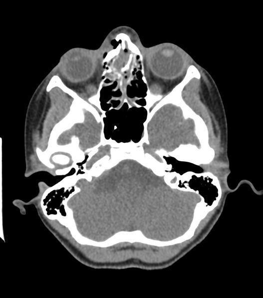 File:Nasoorbitoethmoid fracture (Radiopaedia 90044-107205 Axial non-contrast 151).jpg