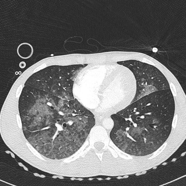 File:Near drowning (pulmonary edema) (Radiopaedia 24685-24958 lung window 48).jpg