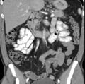 Necrotizing pancreatitis with acute necrotic collection (Radiopaedia 14470-14417 C 19).jpg