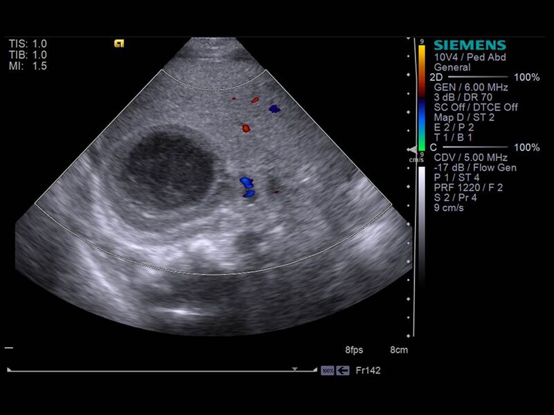 File:Neonatal adrenal hemorrhage (Radiopaedia 40215-42740 Transverse 1).JPG