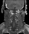Neurofibromatosis type 1 (Radiopaedia 80355-93740 I 9).jpg