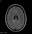 Neurosarcoidosis (Radiopaedia 10930-11351 Axial FLAIR 13).jpg