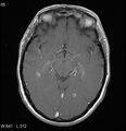 Neurosarcoidosis (Radiopaedia 10930-17204 Axial T1 C+ 8).jpg