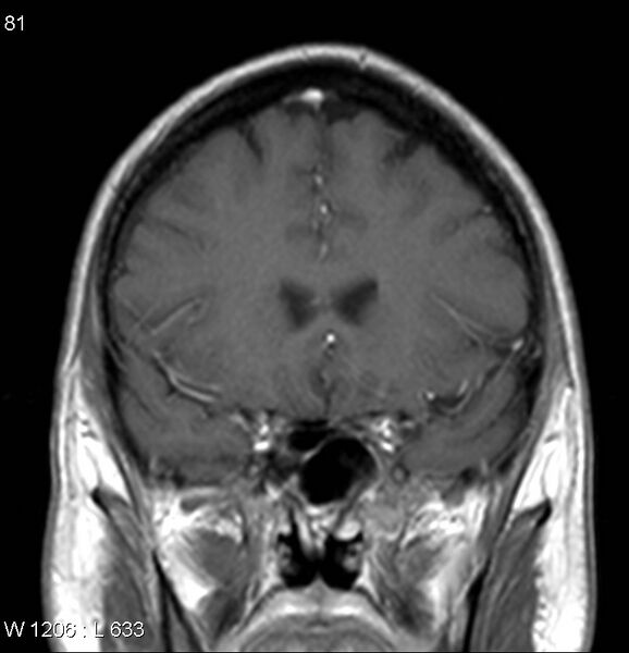 File:Neurosarcoidosis (Radiopaedia 10930-17204 Coronal T1 C+ 5).jpg