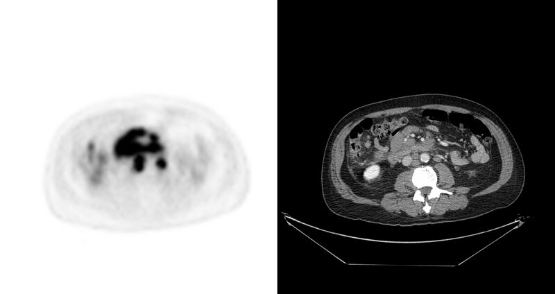 File:Non-Hodgkin lymphoma involving seminal vesicles with development of interstitial pneumonitis during Rituximab therapy (Radiopaedia 32703-33675 axial PET CT 26).jpg