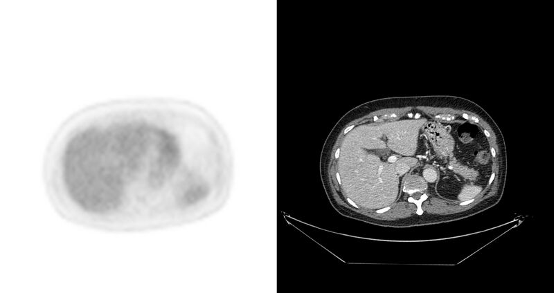 File:Non-Hodgkin lymphoma involving seminal vesicles with development of interstitial pneumonitis during Rituximab therapy (Radiopaedia 32703-33675 axial PET CT 36).jpg