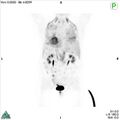 Non-Hodgkin lymphoma involving seminal vesicles with development of interstitial pneumonitis during Rituximab therapy (Radiopaedia 32703-33761 PET cor 3D MIP 7).jpg